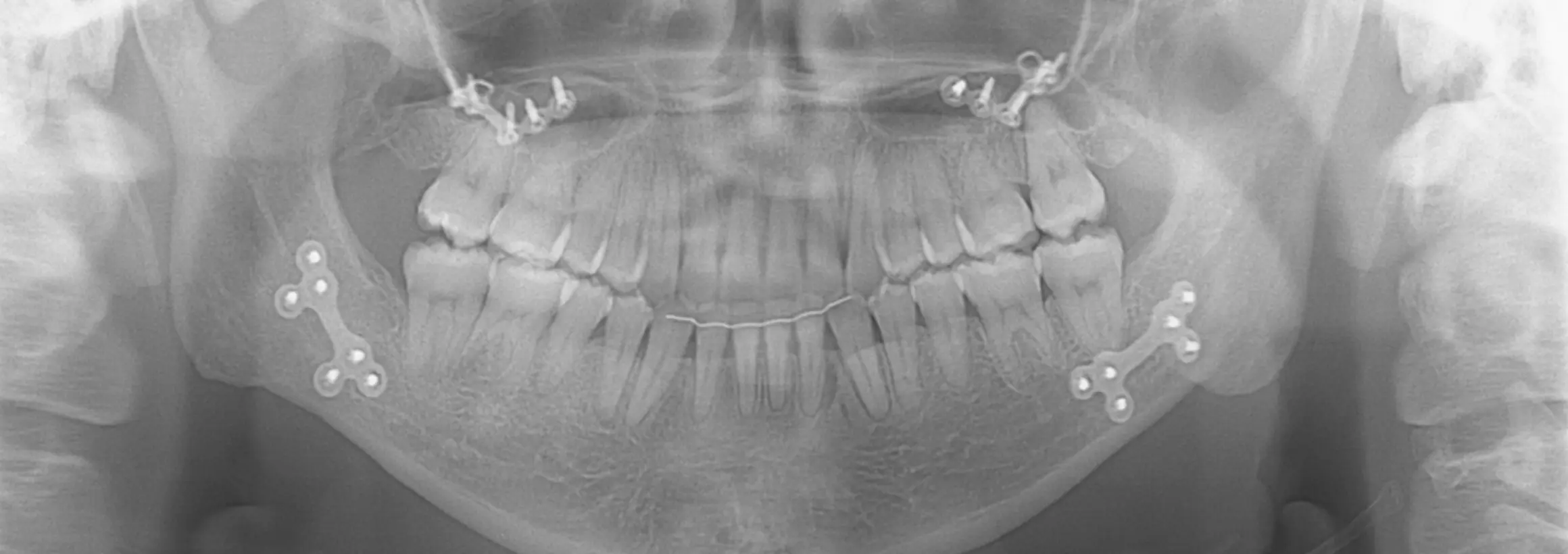 当院のプレート除去