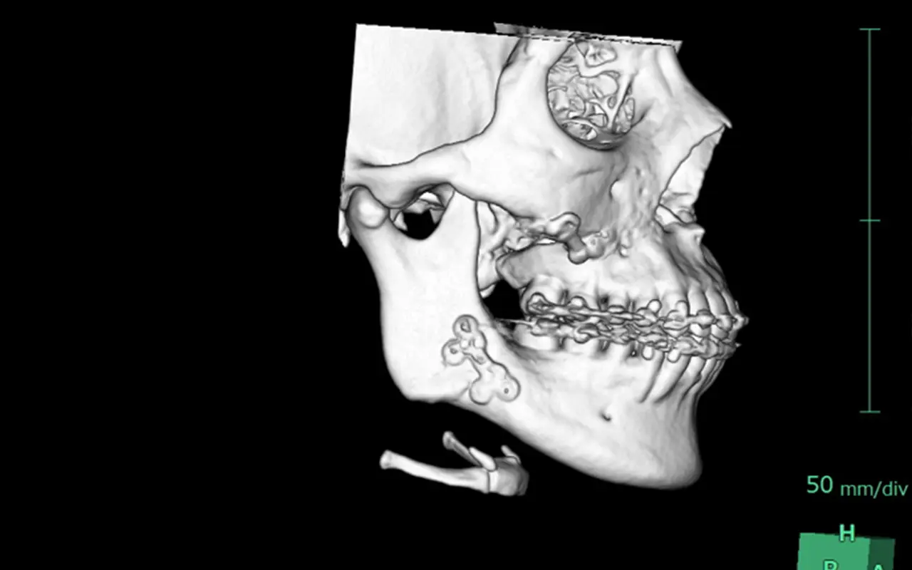 他院で入れたプレート除去をご検討の方へ