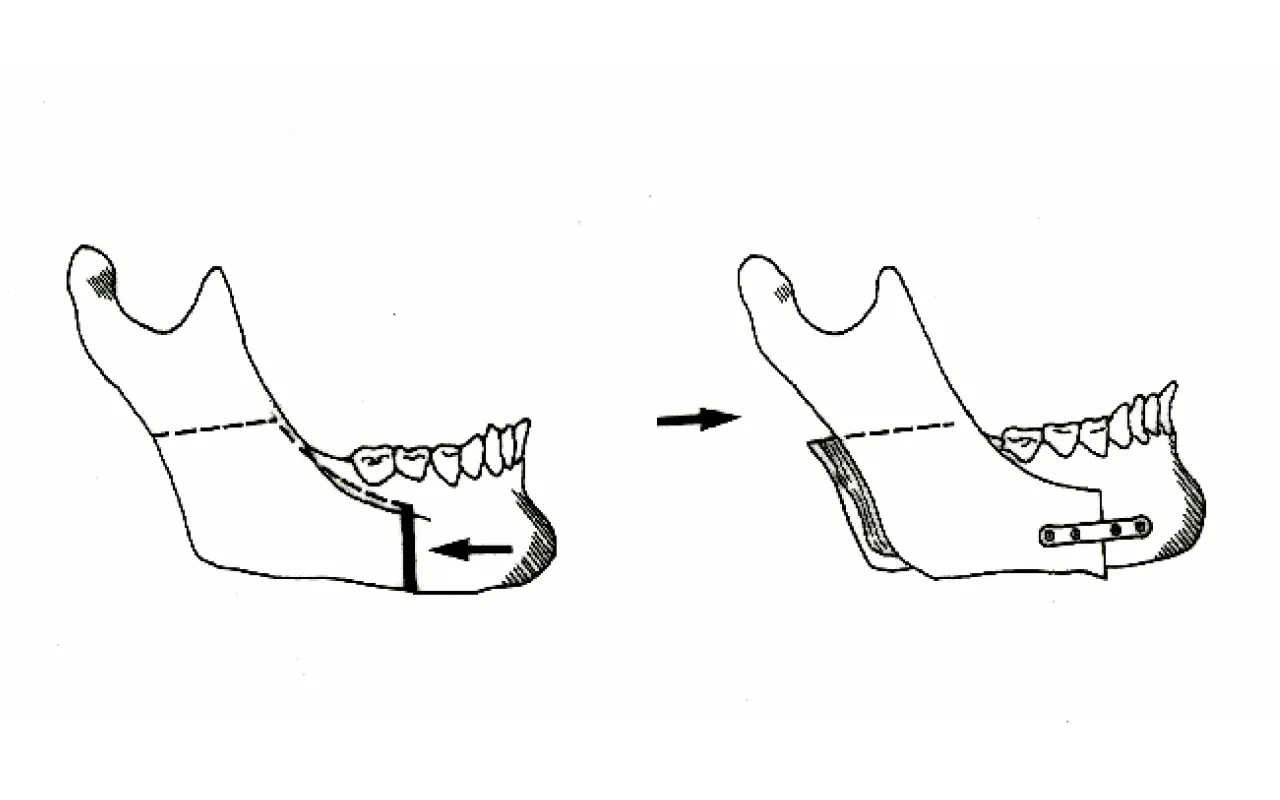 下顎枝矢状分割術(SSRO=Sagittal Split Ramus Osteotomy)