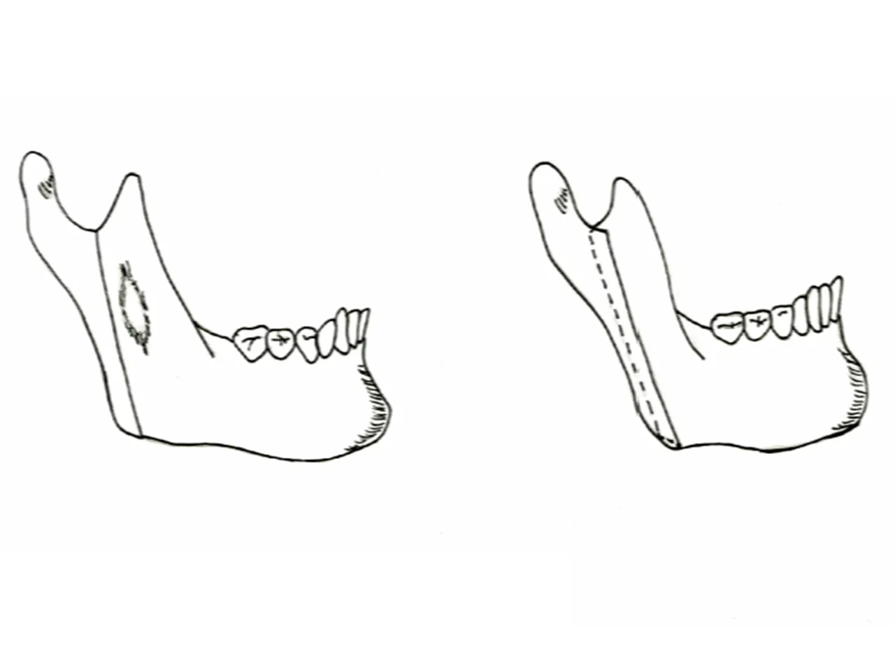 下顎枝垂直骨切り術(IVRO=Intraoral Vertical Ramus Osteotomy)