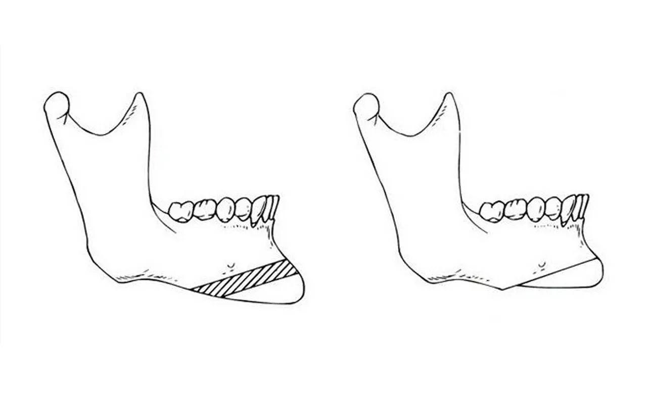 オトガイ形成術