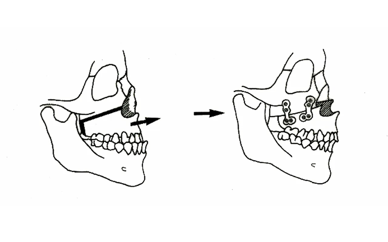 Le Fort(ルフォー)Ⅰ型骨切り術