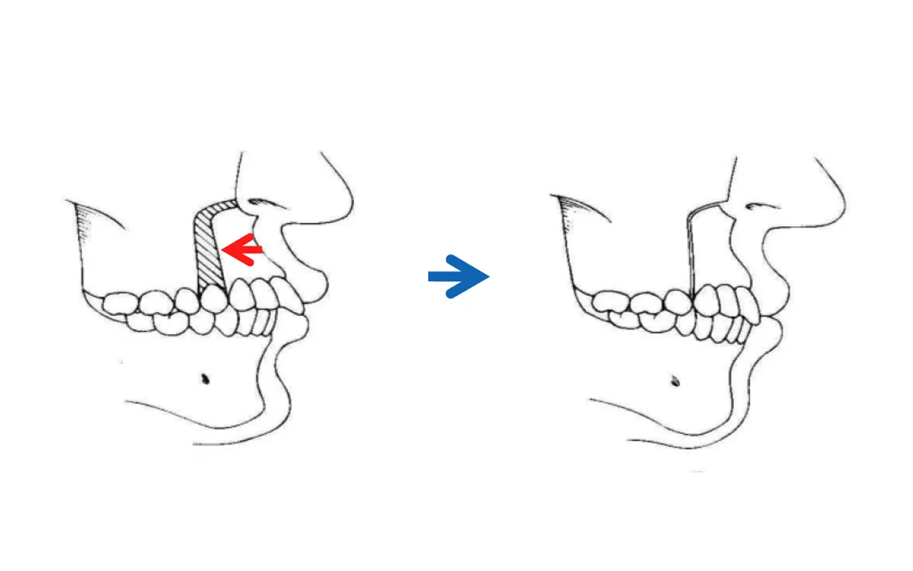 上顎前歯部歯槽骨切り術